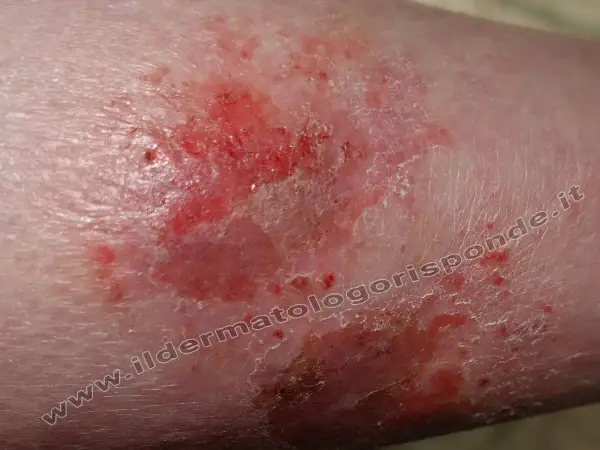 Macchie infiammate e screpolate sulle gambe, con aree arrossate e desquamazione.