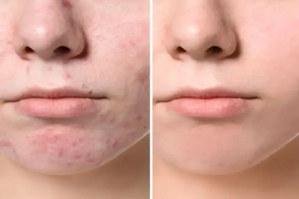 Confronto tra pelle con acne giovanile e pelle trattata, mostrando l'efficacia dei rimedi della nonna.
