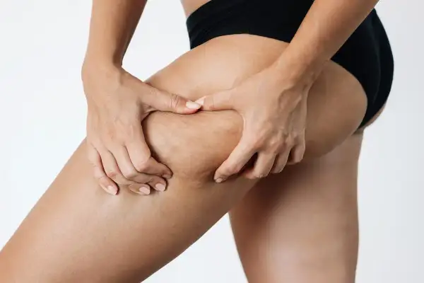 Mani che stringono la coscia, mostrando la texture della pelle con segni di cellulite edematosa. Alla ricerca di rimedi efficaci.
