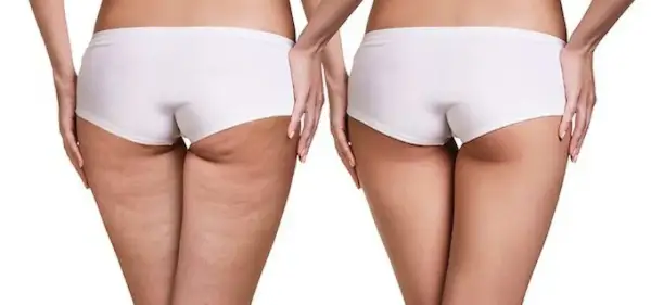 Confronto tra adipe e cellulite: la pelle a sinistra mostra la texture irregolare della cellulite, mentre a destra appare più liscia e tonica.