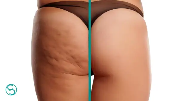 Confronto prima/dopo: la coscia sinistra mostra cellulite primo stadio, la destra pelle liscia e tonica.