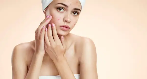 Ragazza con imperfezioni sul viso, preoccupata. Cerca una soluzione non comedogena per la sua pelle.