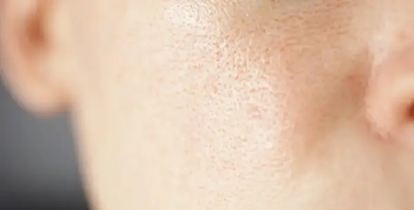 Primo piano della pelle del viso con pori dilatati sulle guance, evidenziando la texture.