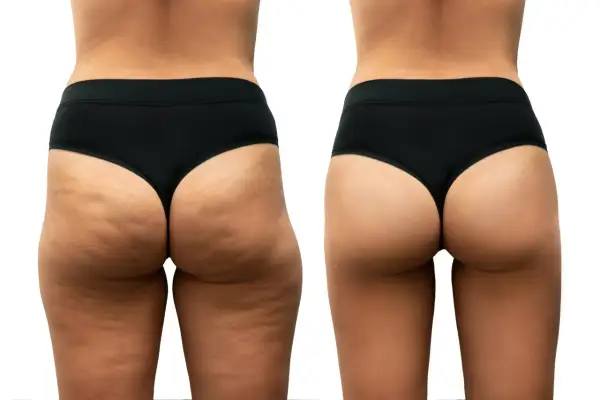 Confronto prima/dopo: la gamba sinistra mostra cellulite dolorosa e irregolarità, la destra appare liscia e tonica.