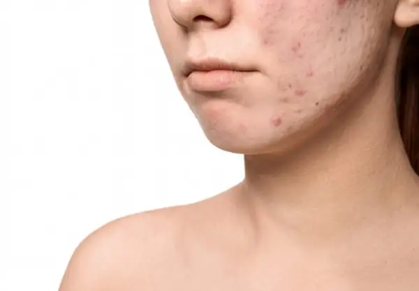 Primo piano di un volto con pelle congestionata e acne. Imperfezioni visibili sul mento e sulla guancia.