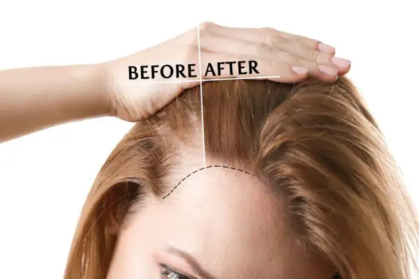 Prima e dopo: capelli più folti grazie ai rimedi della nonna per rinforzare i capelli.