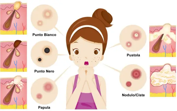Ragazza preoccupata per i brufoli: punto bianco, punto nero, papula, pustola e nodulo/cisti illustrati.